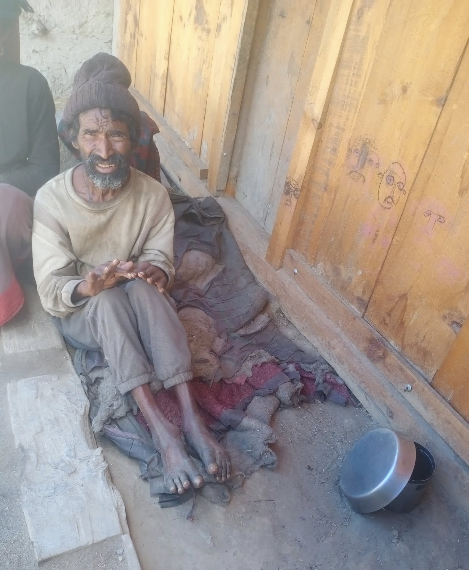उपचारको पखाईमा कुष्ठरोग लागेका धनवीर